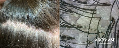 OILY Dandruff vs. DRY Dandruff: Causes, Differences, Symptoms Photos, and Treatments | AROMASE