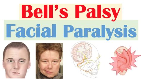 Bell’s Palsy (Facial Paralysis) | Causes, Pathophysiology, Signs & Symptoms, Diagnosis, Treatment