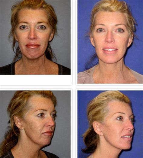 What Does A Mini Facelift Do Photos » Facelift: Info, Prices, Photos, Reviews, Q&A