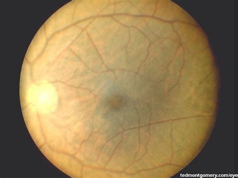 Cystoid Macular Edema