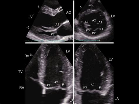 Mitral Valve Prolapse Echocardiogram