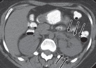 Acute pyelonephritis of left kidney. On this unenhanced image, there is... | Download Scientific ...