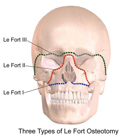 What Is A Le Fort I Osteotomy? - ArchWired