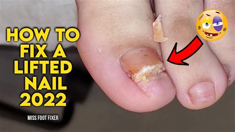 HOW TO FIX A LIFTED NAIL 2022 [ Thick Lifted Toenails] BY MISS FOOT FIXER - YouTube