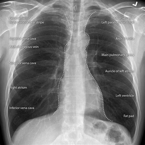 Pin en Chest Radiology