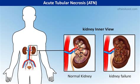 Desi Beats: Symptoms Of Acute tubular necrosis