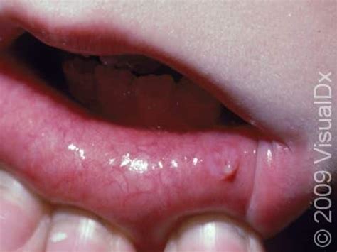 Blocked Salivary Gland On Lip