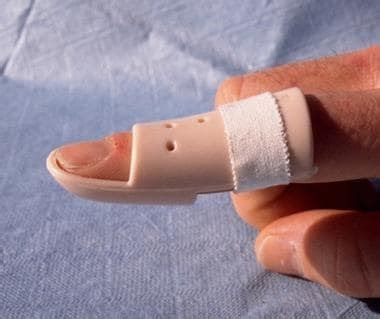 Mallet Finger Treatment & Management: Approach Considerations ...