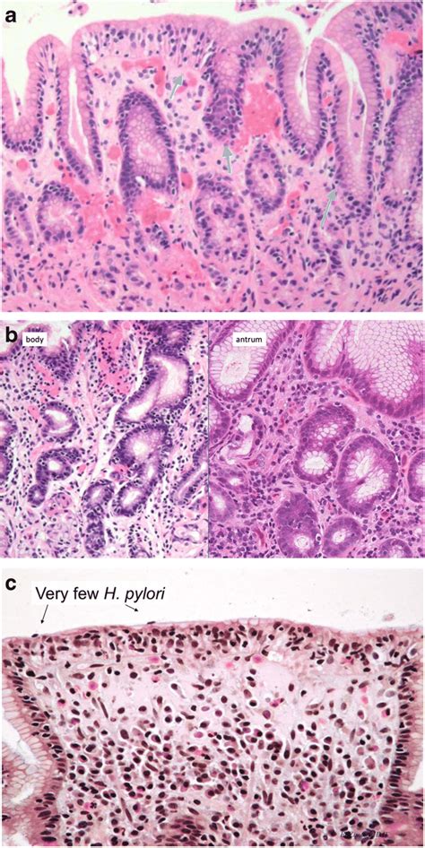 a Lymphocytic gastritis in celiac disease is relatively mild and... | Download Scientific Diagram