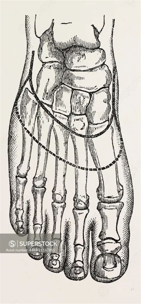 chopart's amputation, medical equipment, surgical instrument, history of medicine - SuperStock