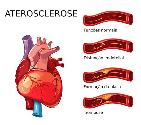 O Que Aterosclerose Fisiopatologia E Causas Arteriosclerose | The Best Porn Website