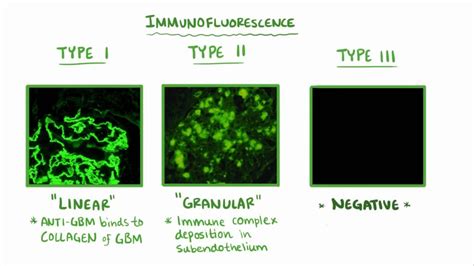 Rapidly progressive glomerulonephritis: Video | Osmosis