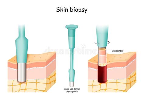 Skin Biopsy. Punch Biopsy Take Skin Sample Stock Vector - Illustration ...