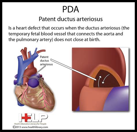 50 best Patent Ductus Arteriosus (PDA) images on Pinterest | Nicu ...