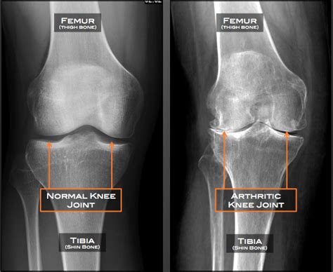 Are anti-inflammatory drugs accelerating your arthritis?