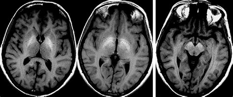 What is the mechanism of encephalopathy?