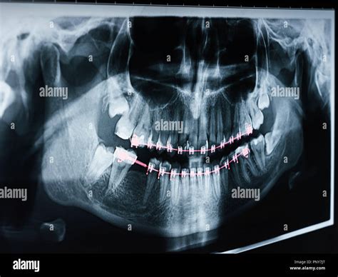 Dental X-Ray Photo Of Human Skull And Teeth With Braces Stock Photo - Alamy