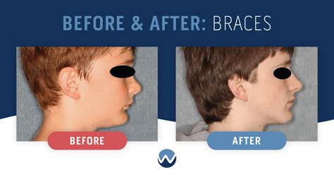 Before & After Braces: See the Amazing Results Yourself! • Woodhill Dental Specialties