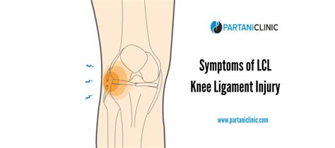 Symptoms of LCL Knee Ligament Injury - Partani Clinic