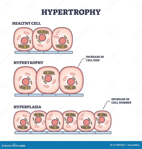 Hypertrophy, Hyperplasia Or Healthy Muscular Cells Comparison Outline ...