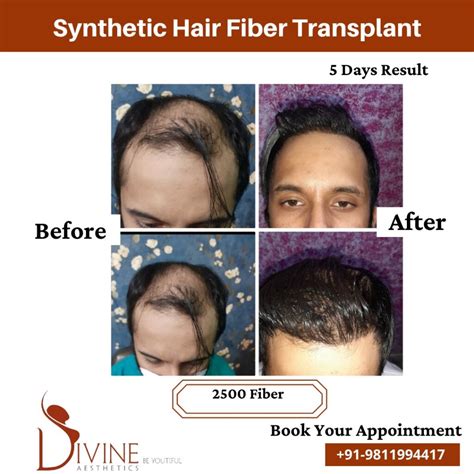 Best Bio Synthetic Hair Implant Cost in Delhi | Artificial Hair Implant