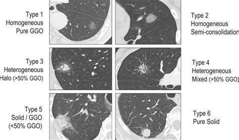 What Is A Ground Glass Opacity Nodule - Glass Designs