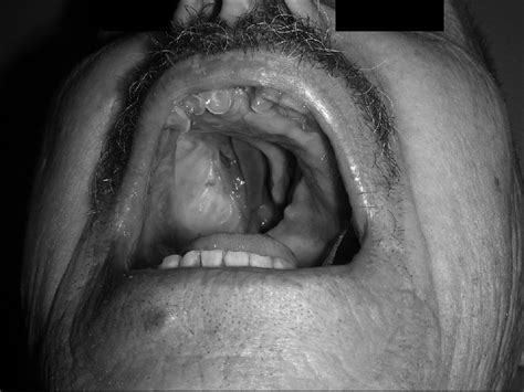 Preoperative view of the oronasal fistula | Download Scientific Diagram