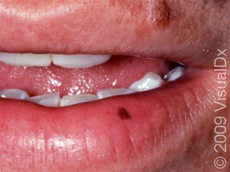 Oral Melanotic Macule: Symptoms and Treatment - Skinsight