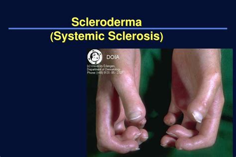 PPT - Scleroderma ( Systemic Sclerosis ) PowerPoint Presentation, free ...