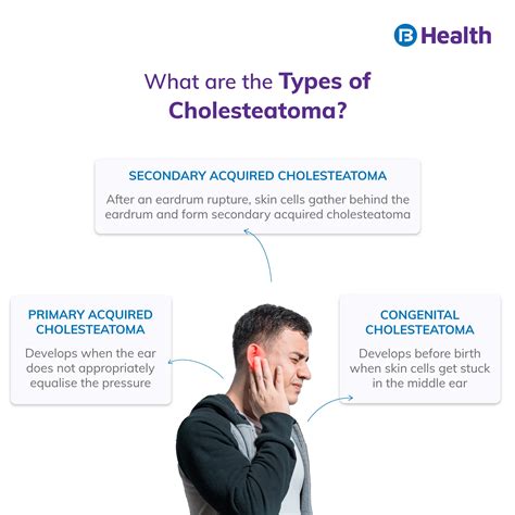 Cholesteatoma: Meaning, Symptoms, Causes, and Type