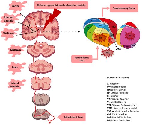 Frontiers | Central Post-Stroke Pain: An Integrative Review of Somatotopic Damage, Clinical ...