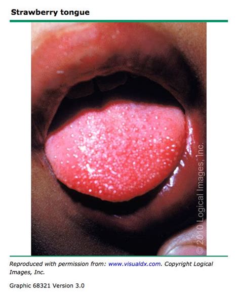 Strep Throat Bumps On Tongue | Images and Photos finder