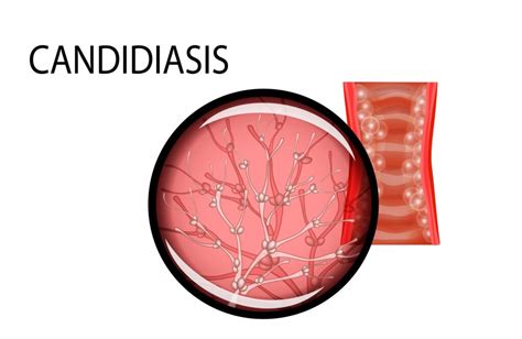 Early Signs and Symptoms of Candidiasis Infection - Health Works Collective