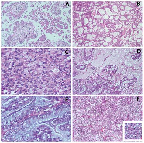 Morphology of ALK-rearrangement lung adnenocarcinoma. (A) papillary and... | Download Scientific ...