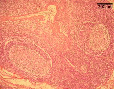 Lingual Tonsil Histology