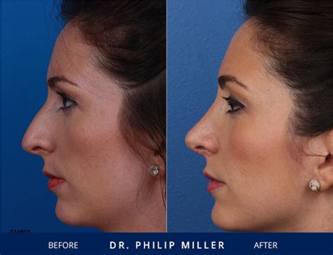 Nose job gallery of NYC patients | Before & after photos