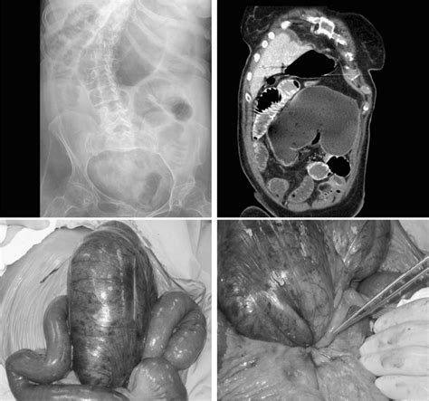 Acute Gastrointestinal Diseases | Anesthesia Key