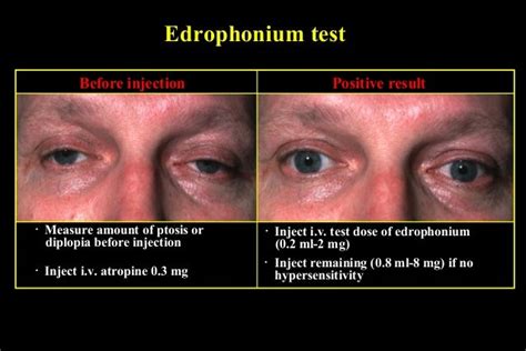 ptosis