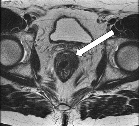 MRI of Rectal Cancer: Tumor Staging, Imaging Techniques, and Management ...