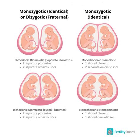 What are Monochorionic-Diamniotic Twins? - Definition from FertilitySmarts | Medical ...