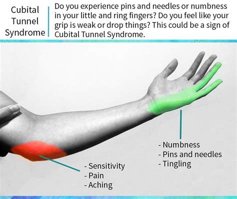 CUBITAL TUNNEL SYNDROME Is the... - Guernsey Hand Therapy