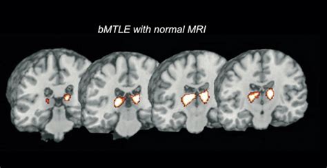 Chapter 5 – Imaging Genetics for Benign Mesial Temporal Lobe Epilepsy | Neupsy Key