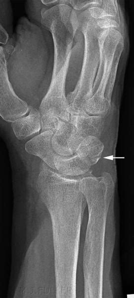 Triquetrum Fracture - Hand - Orthobullets