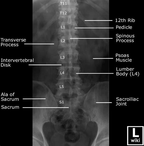 Lumbar Spine Radiographic Anatomy | Diagnostic imaging, Radiology student, Medical anatomy