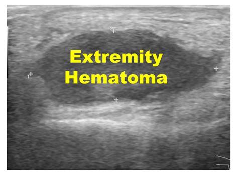 emDOCs.net – Emergency Medicine EducationExtremity Hematoma: When to ...