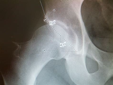 Hip Labral Tear Repair Impingment FAI Arthroscopic Surgery Dysplasia