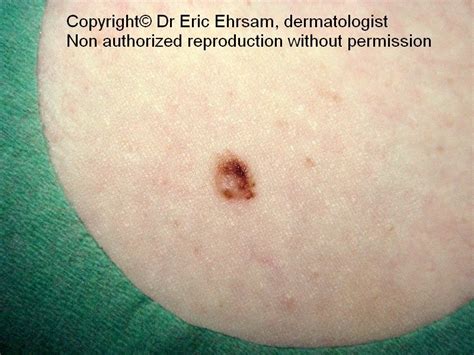 dermoscopy: Atypical melanocytic nevus