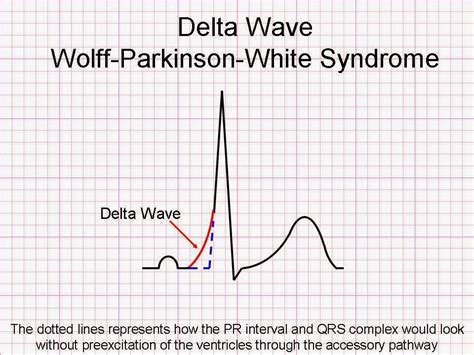 Sindrom Wolff-Parkinson-White | INA - ECG