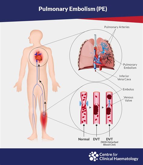 Pulmonary Embolism | CFCH | Centre for Clinical Haematology