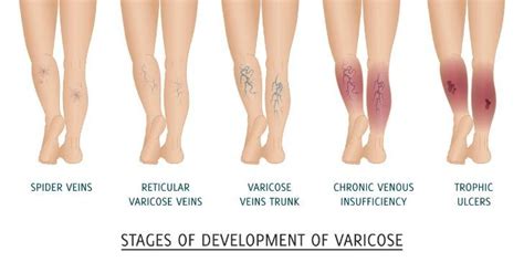 Varicose Veins During Pregnancy: Causes & Tips